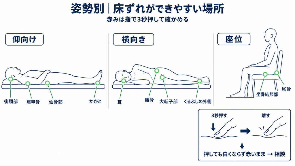 仰向け・横向き・座位それぞれで床ずれができやすい部位を示した人体図と、指で押して確かめる方法の図解
